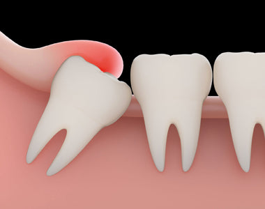 How to Treat Wisdom Tooth Pain?